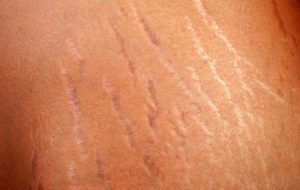 Stretch Marks On The Body